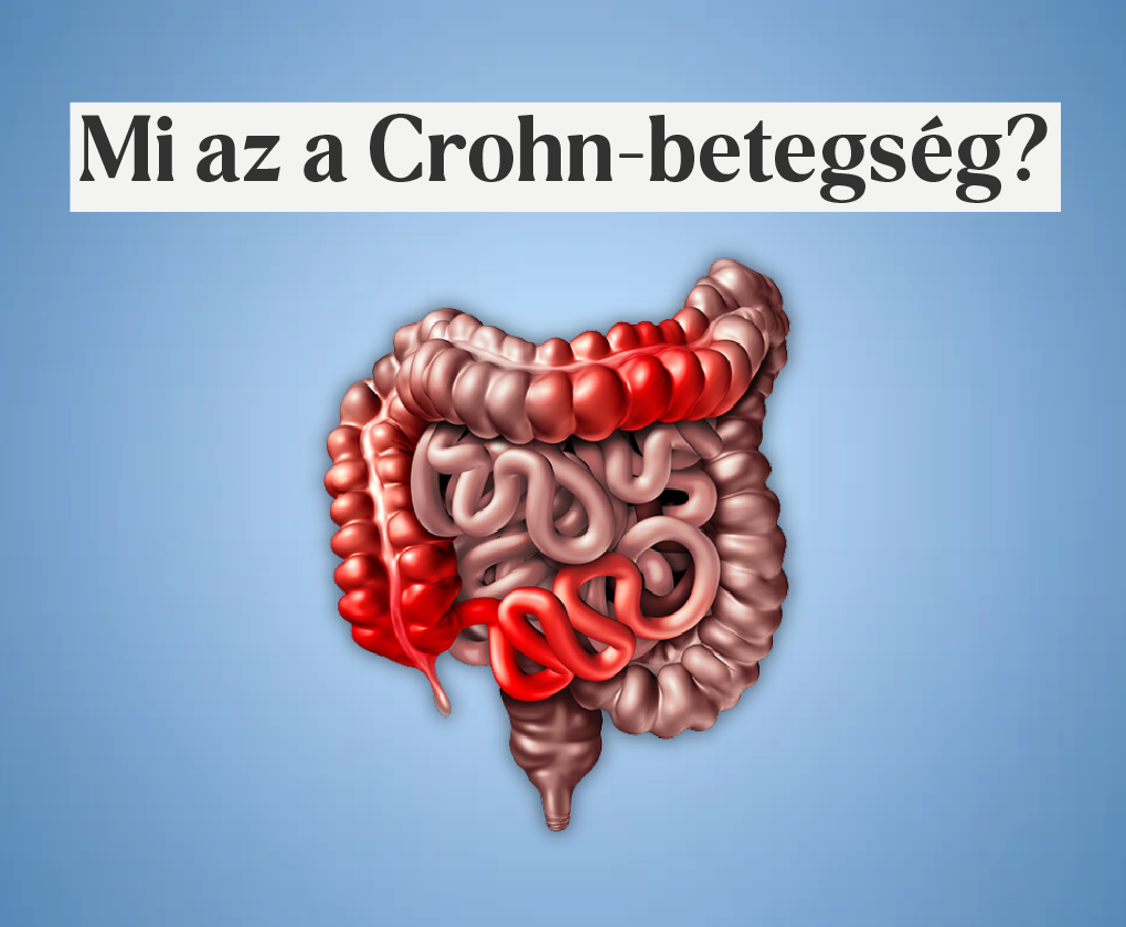 Crohn-betegség – egy krónikus betegség, ami nem gyógyítható teljesen