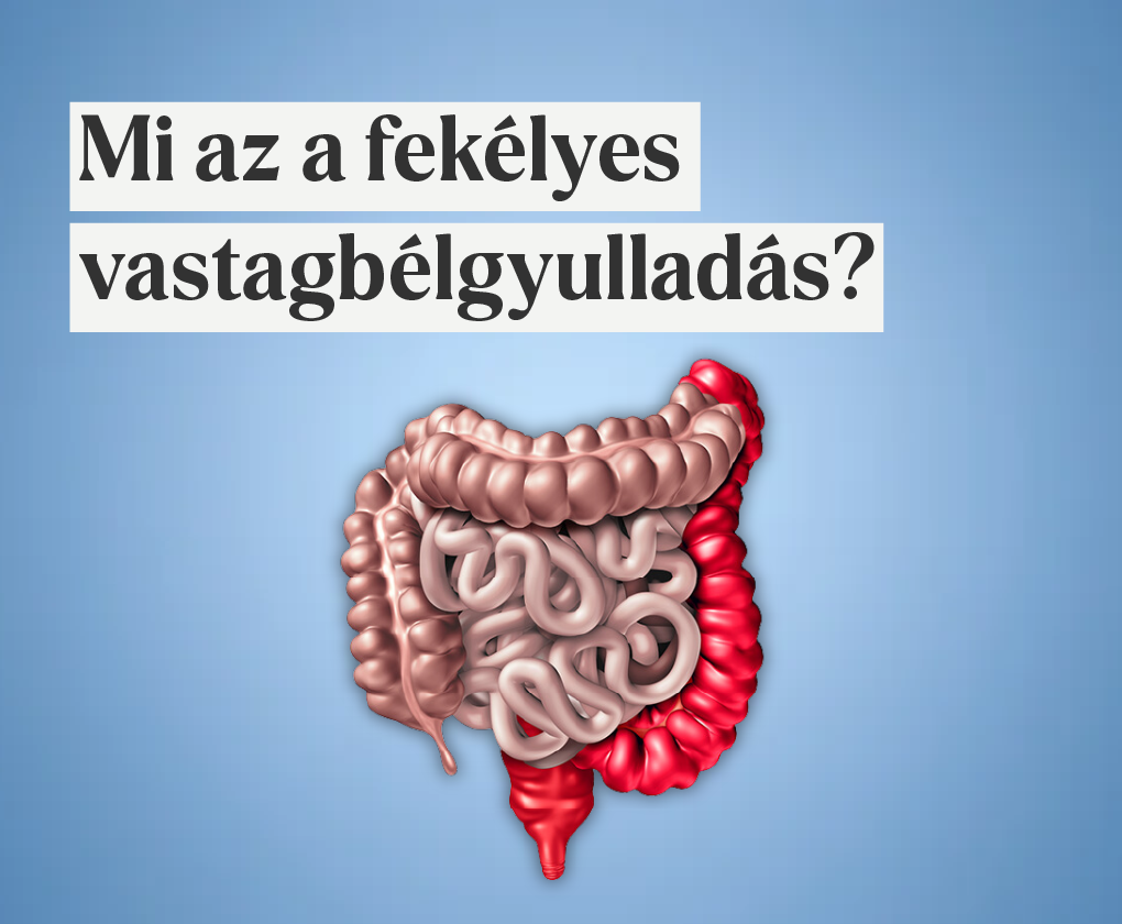 Fekélyes vastagbélgyulladás, avagy Colitis ulcerosa – tünetek, diagnózis és kezelés