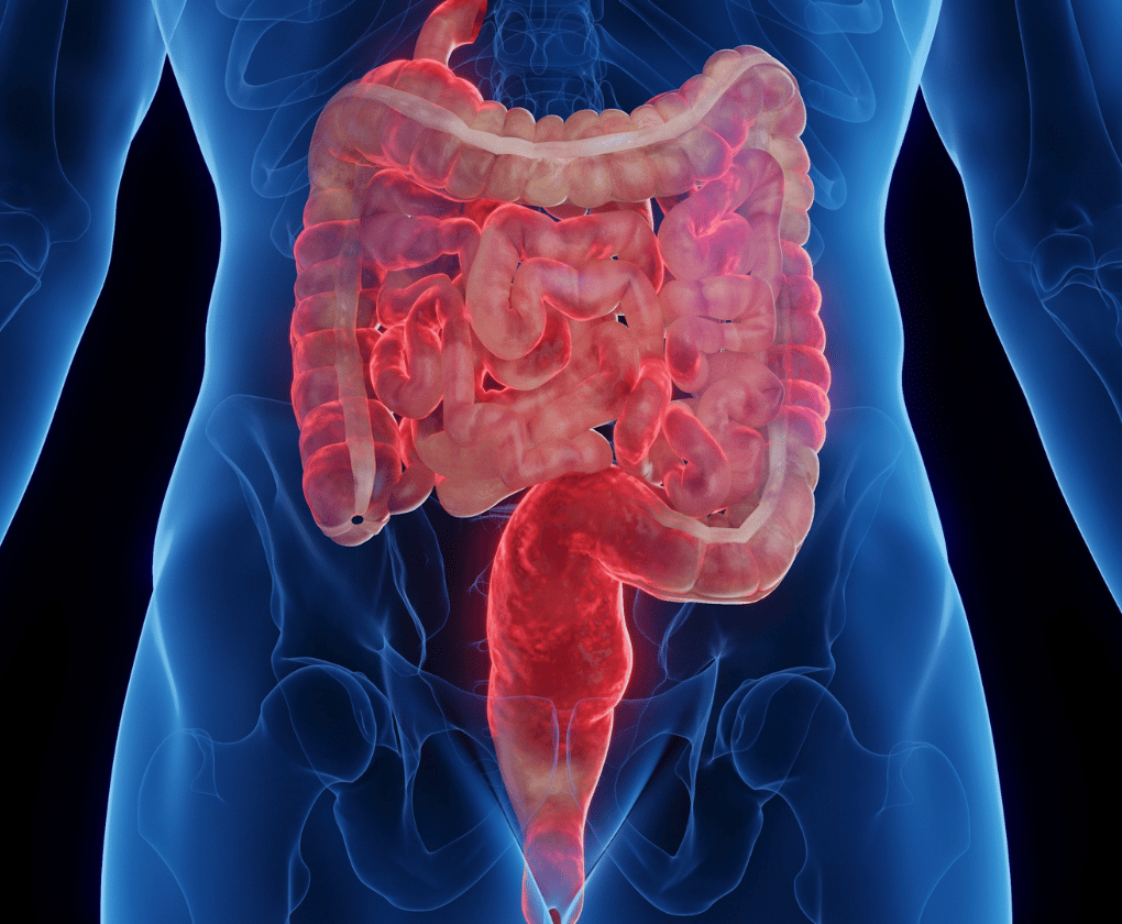 Probiotikumok vs. fekélyes vastagbélgyulladás (colitis ulcerosa) és a Crohn-betegség